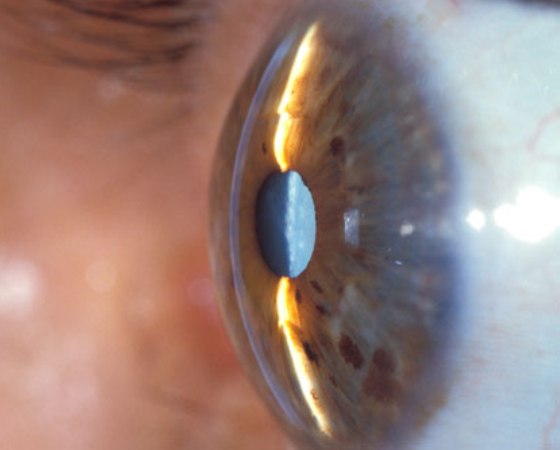 ΚΑΤΑΡΡΑΚΤΗΣ